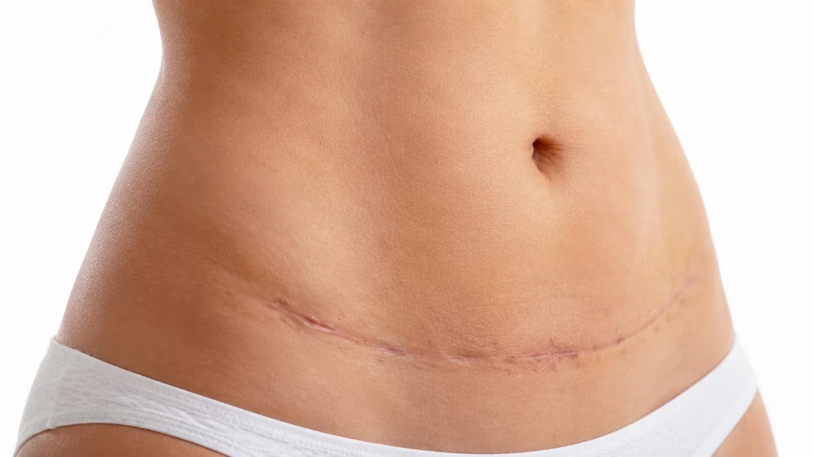 Cicatrice de chirurgie abdominale en cours de maturation.