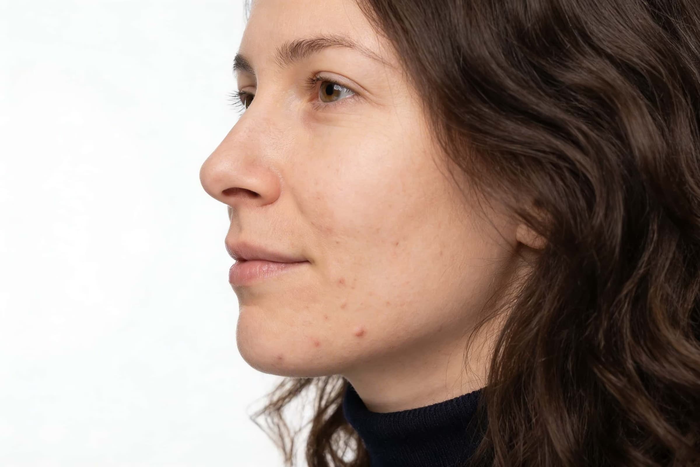 Profil d’une femme adulte presentant une acne legere sur la joue.