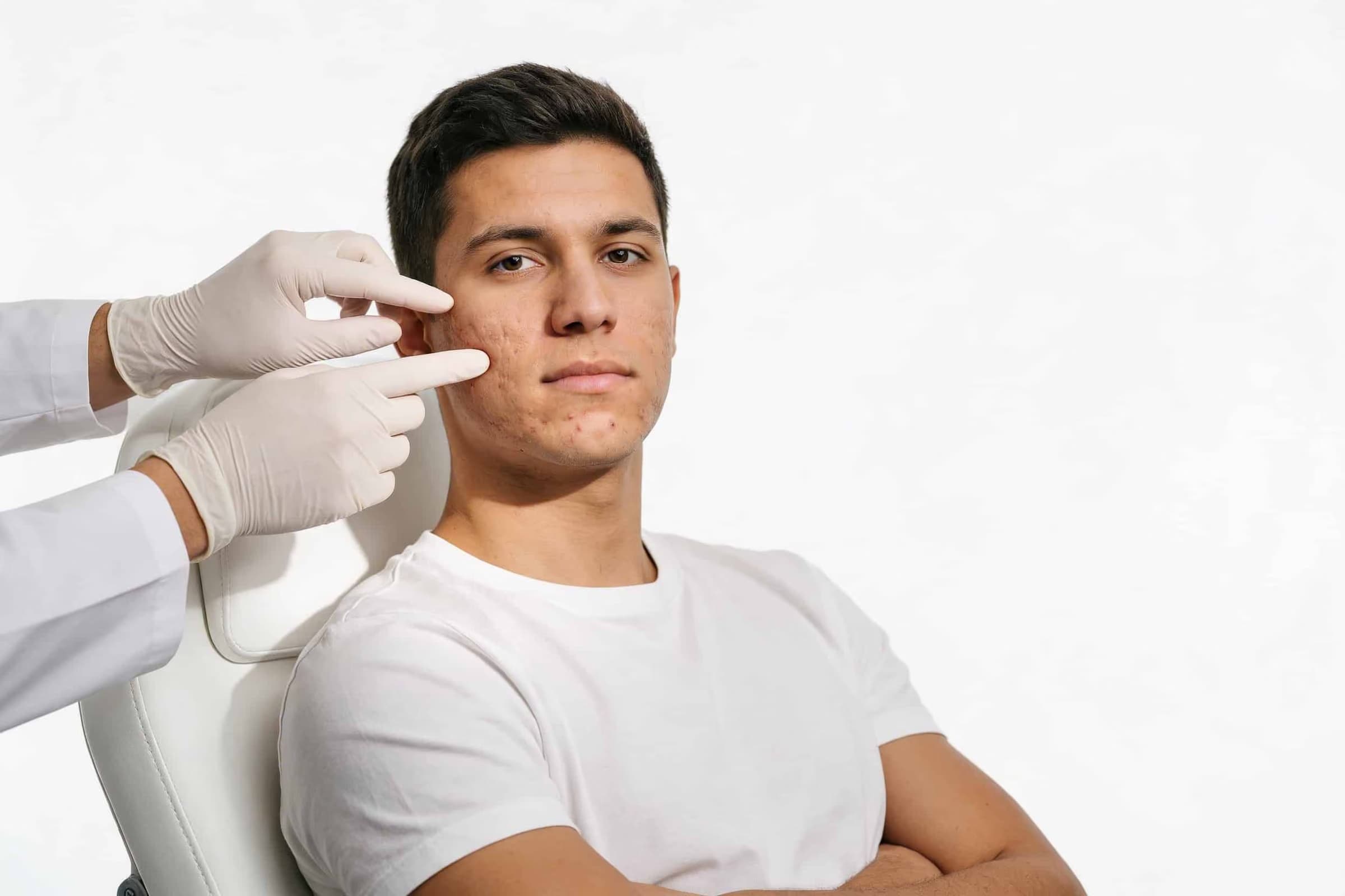 Peau marquée par des cicatrices d’acné en gros plan.