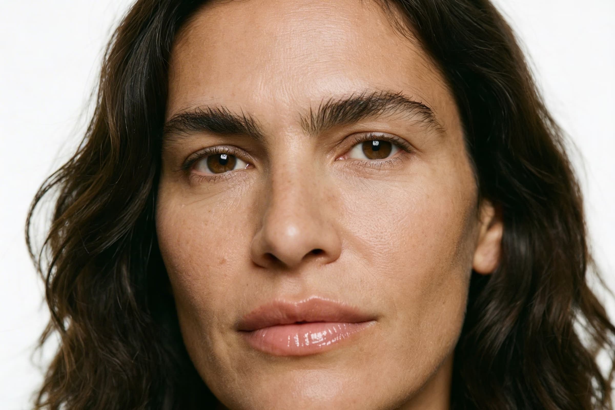 Patches of melasma on the face, in natural light.