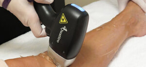 Read more about the article Permanent laser hair removal for clear, smooth skin